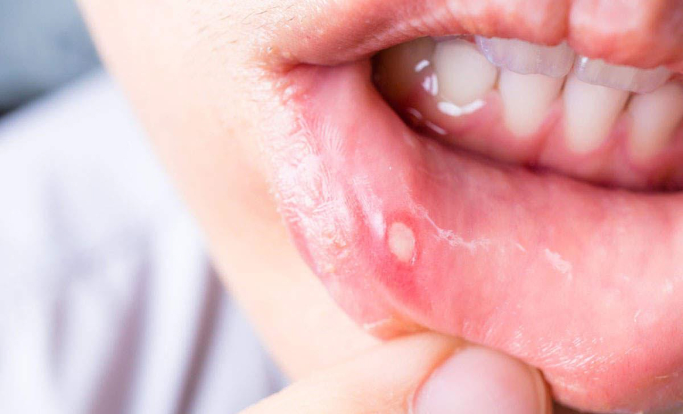 Oral Ulcers and Burning